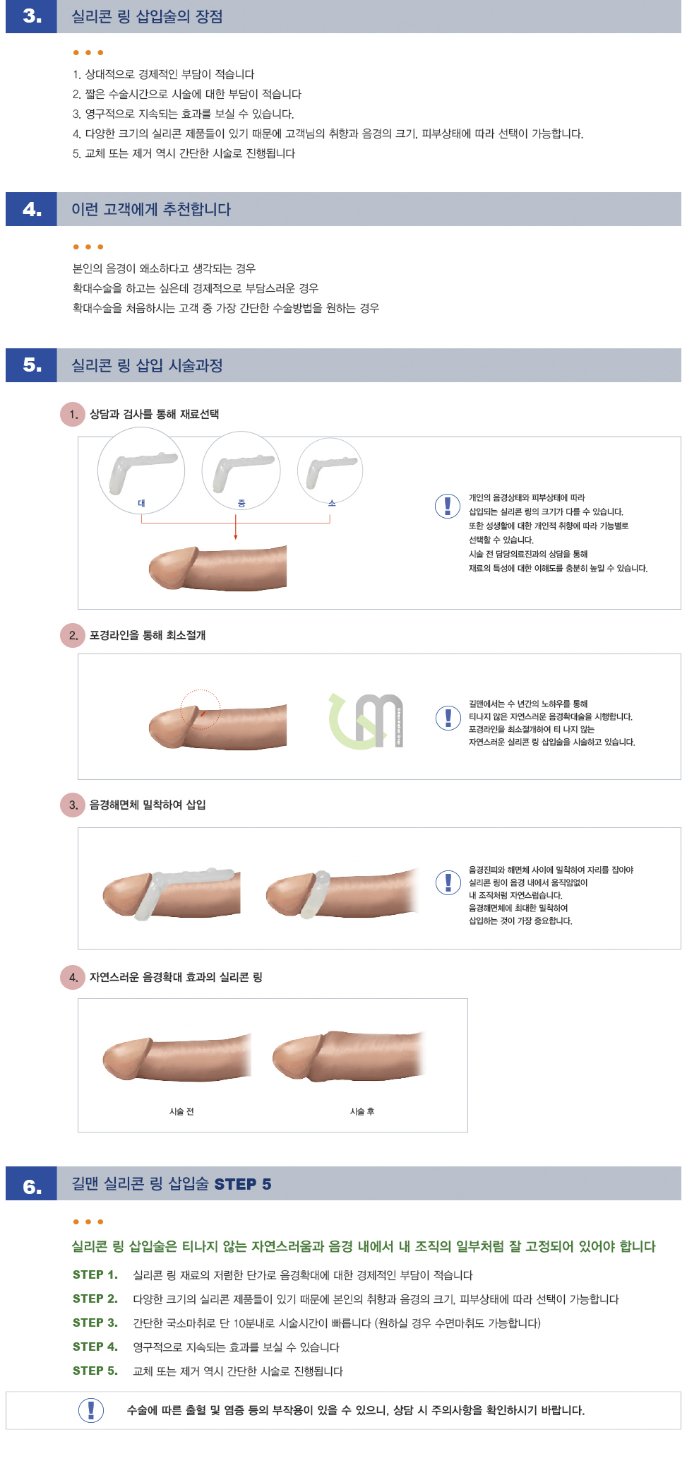 실리콘링 삽입술